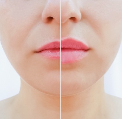 Before and after woman's lips from thin to thick