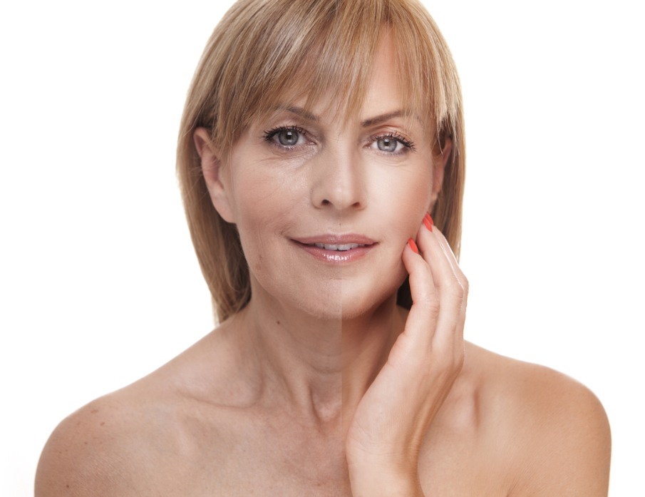 Woman with before and after Skin Rejuvenation